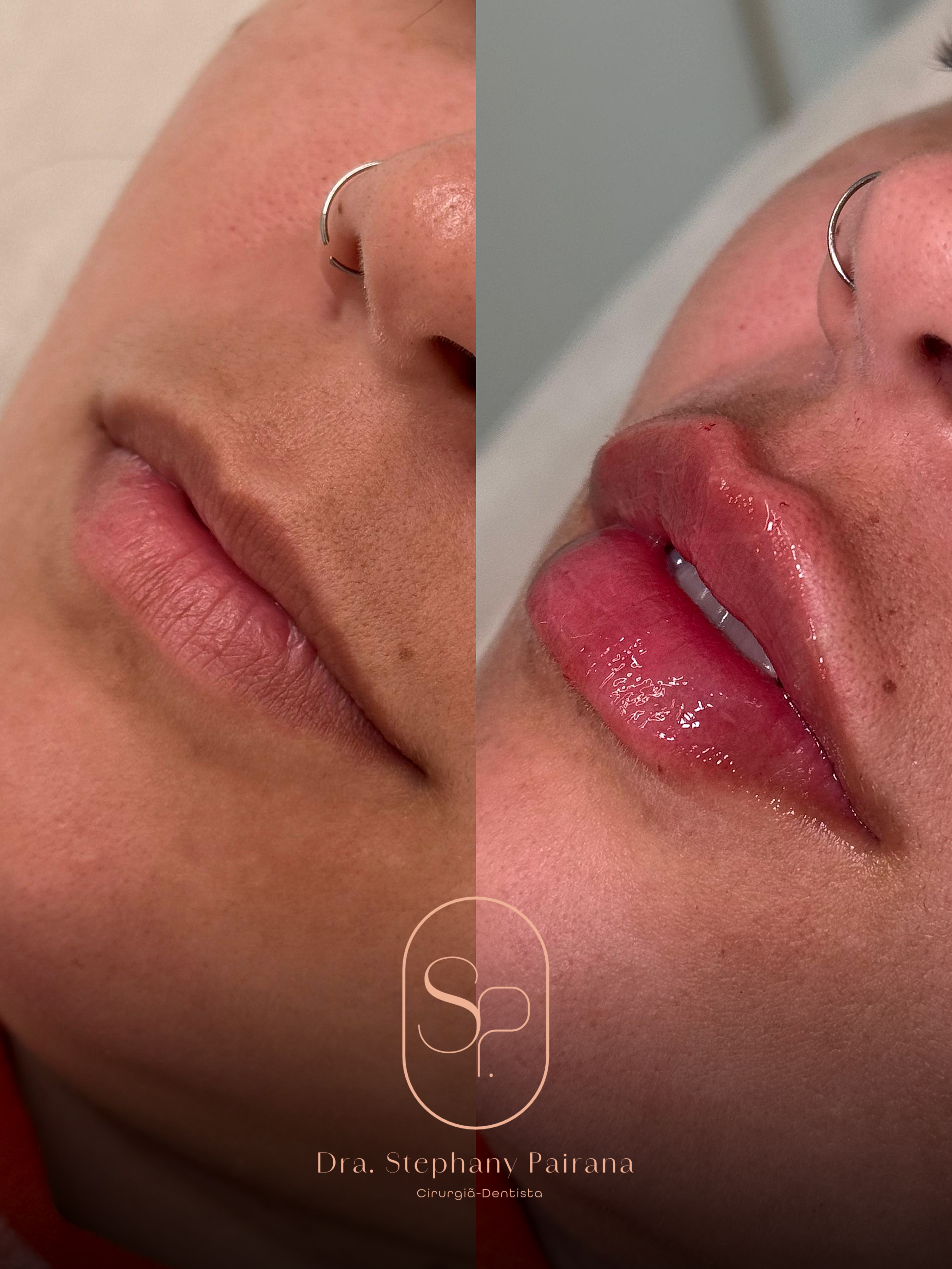 Resultado Preenchimento Labial